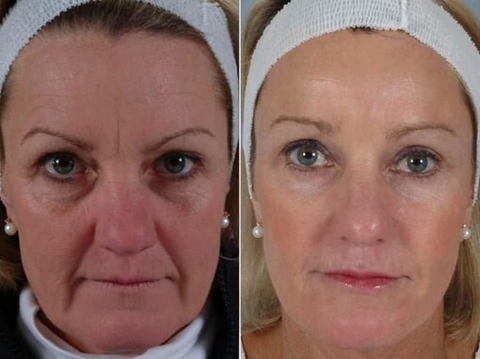 CollagenLift Pro